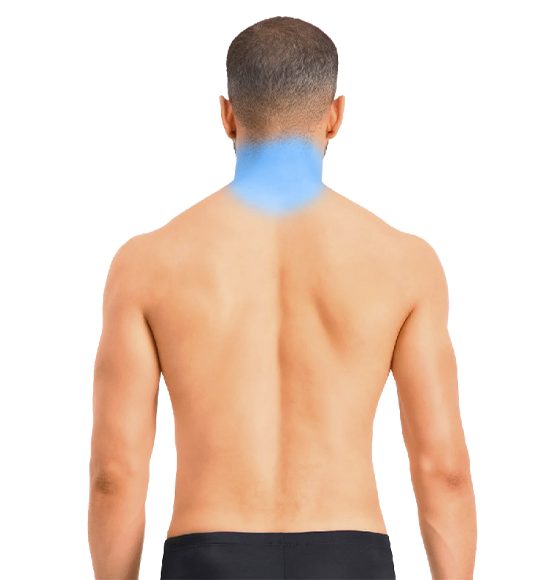 Depilación Láser Hombre - Cuello posterior