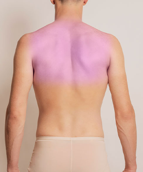 Depilación Láser Hombre - Media Espalda